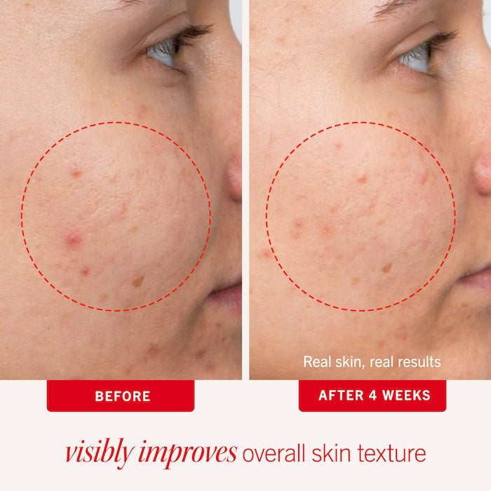 First Aid Beauty 
Acne Clearing Pads - 2% Salicylic Acid Acne Treatment