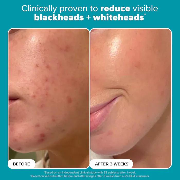 Paula's Choice Skin Perfecting 2% BHA Exfoliating Toner