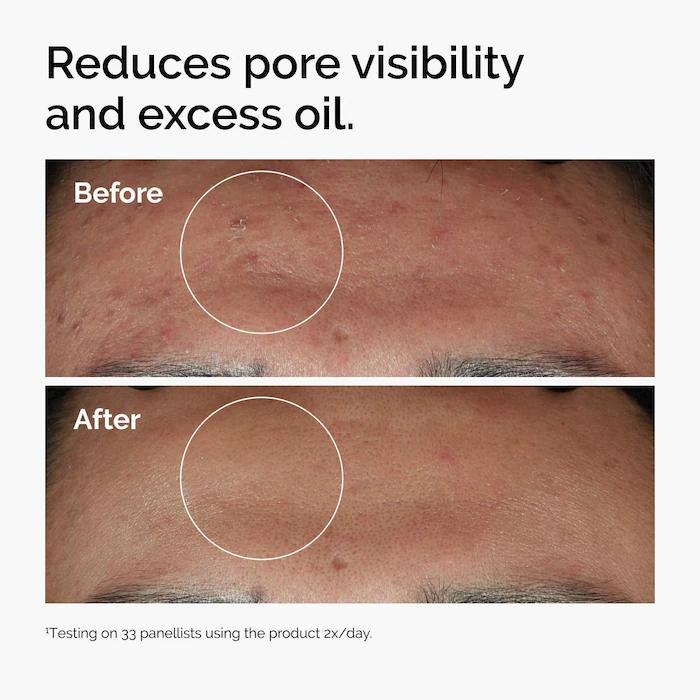 The Ordinary Niacinamide 10% + Zinc 1%  Serum for Oily Skin