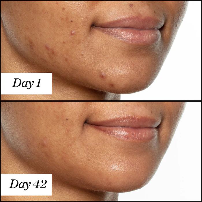 Sunday Riley U.F.O. Salicylic Acid BHA Acne Treatment Face Oil